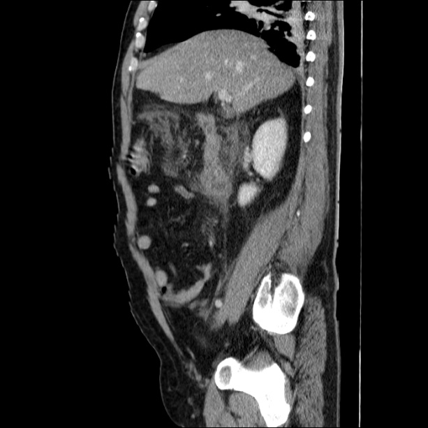 Acute pancreatitis (Radiopaedia 26663-26813 Sagittal C+ portal venous phase 27).jpg