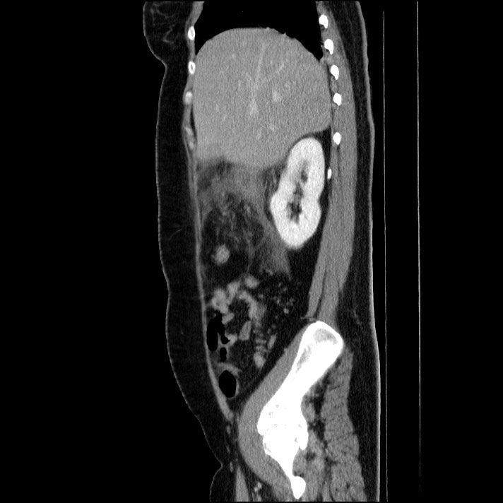 Acute pancreatitis (Radiopaedia 69236-79012 Sagittal C+ portal venous phase 71).jpg