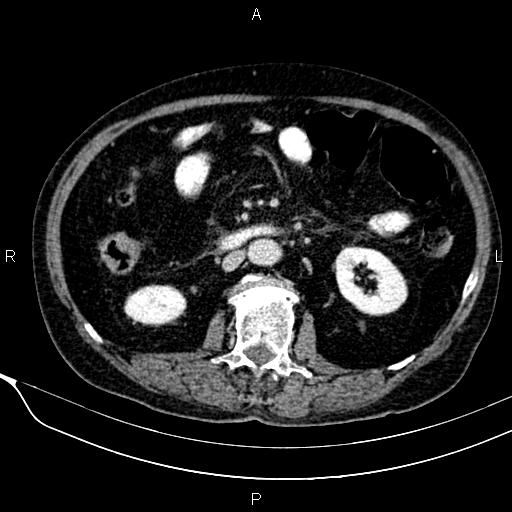 Acute pancreatitis (Radiopaedia 85146-100701 Axial C+ portal venous phase 33).jpg