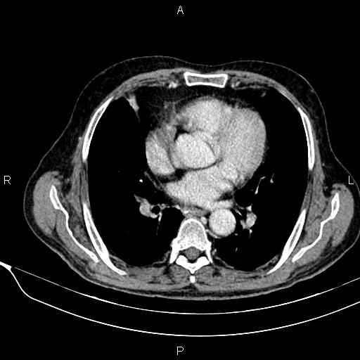 Acute pancreatitis (Radiopaedia 85146-100701 Axial C+ portal venous phase 7).jpg