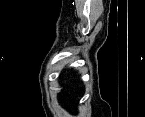 Acute pancreatitis (Radiopaedia 85146-100701 Sagittal C+ portal venous phase 95).jpg