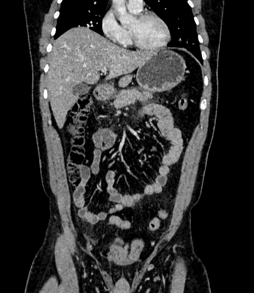 Acute pancreatitis (Radiopaedia 87428-103757 Coronal C+ portal venous phase 33).jpg