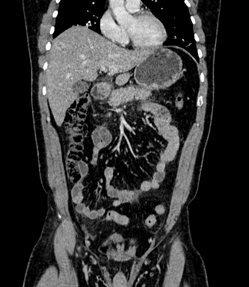 Acute pancreatitis (Radiopaedia 87428-103757 Coronal C+ portal venous phase 34).jpg