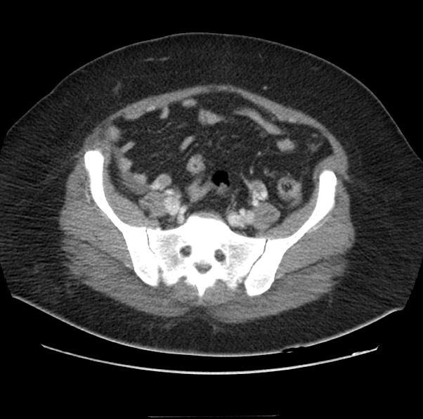 Acute pancreatitis - Balthazar E (Radiopaedia 29016-29377 Axial C+ portal venous phase 55).png