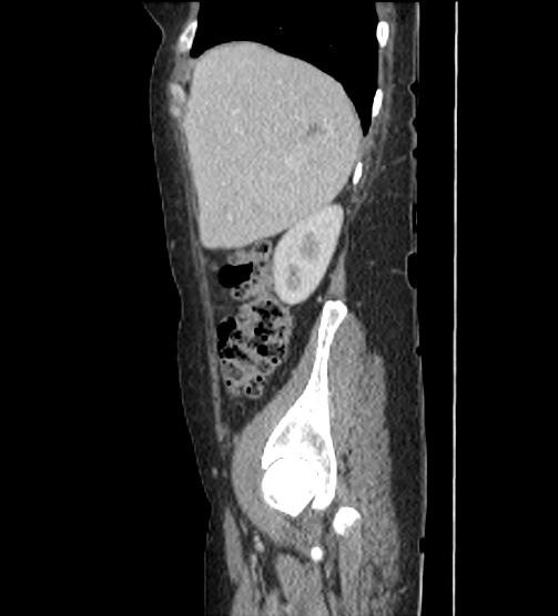 File:Acute pancreatitis - Balthazar E - post ERCP (Radiopaedia 27562-27772 Sagittal C+ portal venous phase 21).png