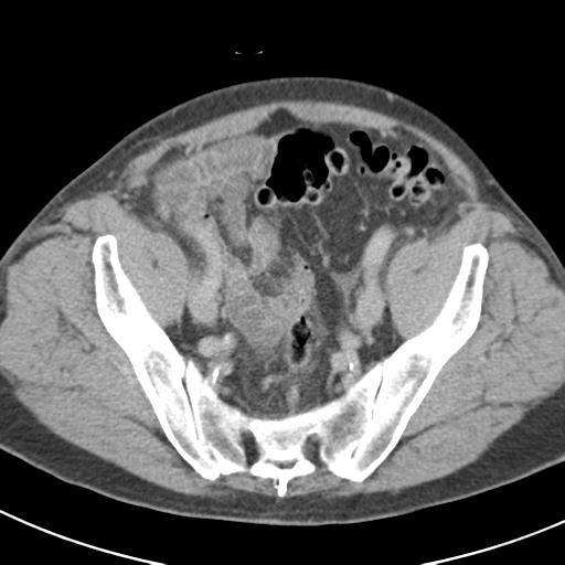 Acute pancreatitis and walled-off necrosis (Radiopaedia 29888-30403 Axial C+ delayed 69).jpg