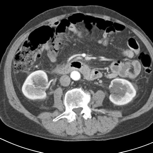 File:Acute pancreatitis and walled-off necrosis (Radiopaedia 29888-30403 Axial C+ portal venous phase 28).jpg