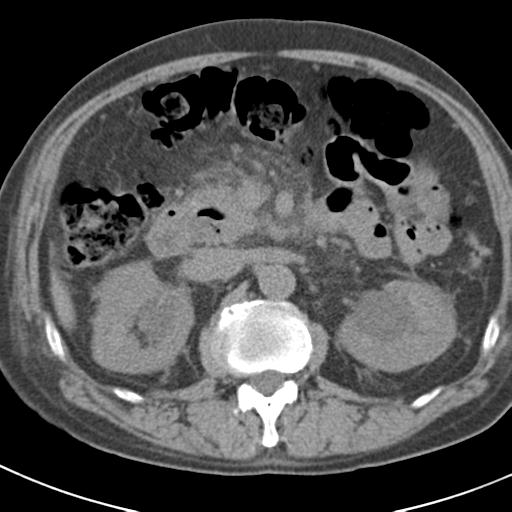 File:Acute pancreatitis and walled-off necrosis (Radiopaedia 29888-30403 Axial non-contrast 27).jpg