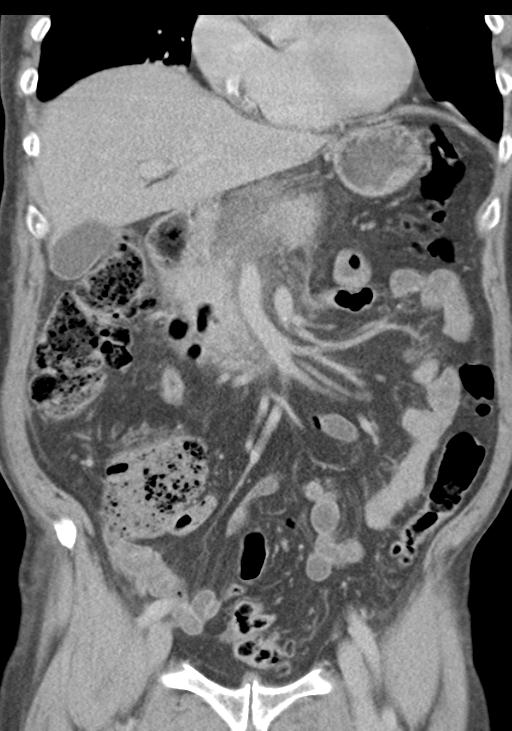 Acute pancreatitis and walled-off necrosis (Radiopaedia 29888-30403 E 23).jpg