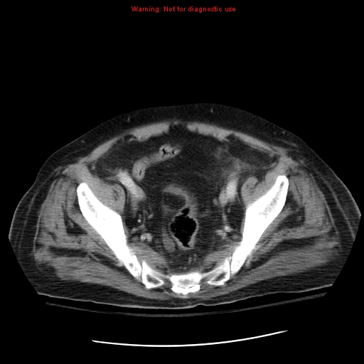 File:Acute pancreatitis with incidental pancreatic lipoma (Radiopaedia 10190-10730 Axial C+ portal venous phase 66).jpg