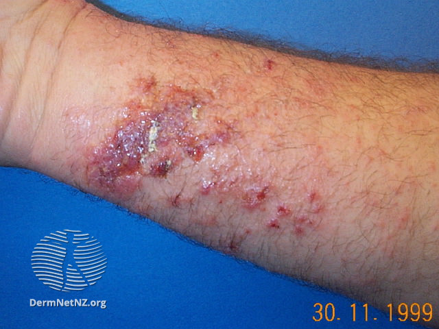 File:Acute phytophotodermatitis, which was followed by hyperpigmentation (DermNet NZ colour-wild-carrot2).jpg