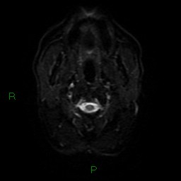 Acute posterior cerebral artery territory infarct (Radiopaedia 79329-92394 Axial DWI 29).jpg