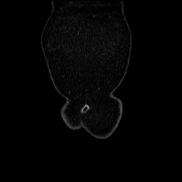 Acute pyelonephritis (Radiopaedia 33397-34434 Coronal renal parenchymal phase 9).jpg