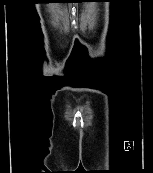 Acute renal infarction (Radiopaedia 59375-66736 Coronal C+ portal venous phase 62).jpg