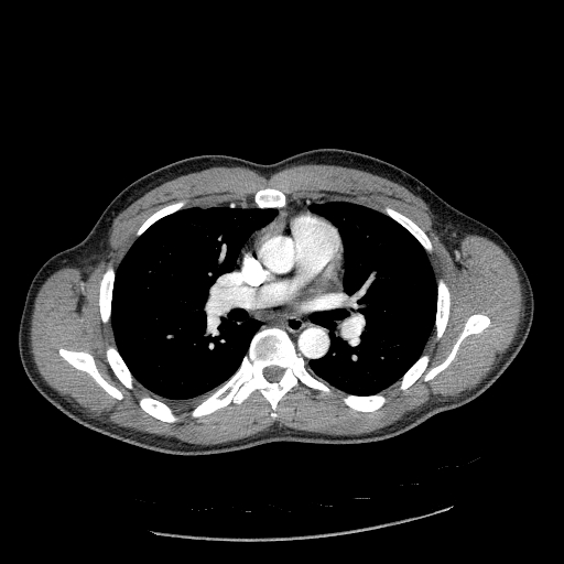 Acute segmental pulmonary emboli and pulmonary infarction (Radiopaedia 62264-70444 Axial C+ CTPA 54).jpg