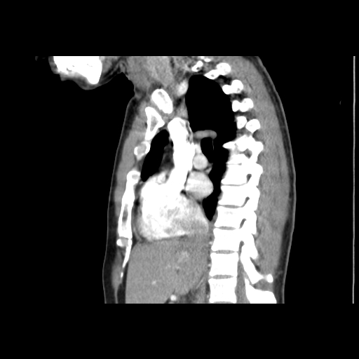 Acute segmental pulmonary emboli and pulmonary infarction (Radiopaedia 62264-70444 Sagittal C+ CTPA 31).jpg