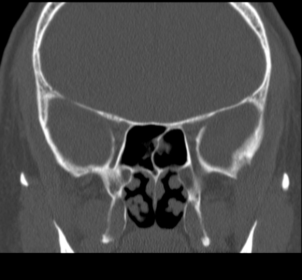 Acute sinusitis (Radiopaedia 23161-23215 Coronal bone window 45).jpg