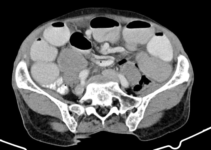 Acute small bowel (ileal) volvulus (Radiopaedia 71740-82139 Axial C+ portal venous phase 140).jpg