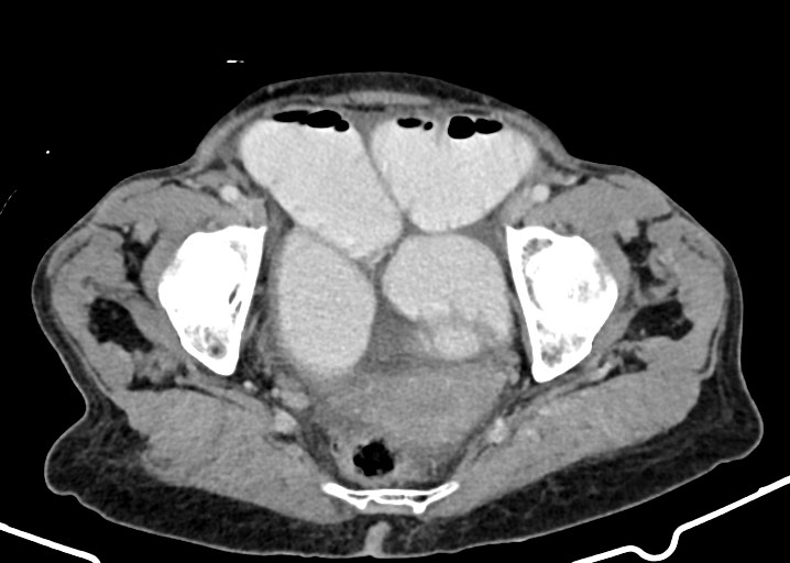 Acute small bowel (ileal) volvulus (Radiopaedia 71740-82139 Axial C+ portal venous phase 177).jpg