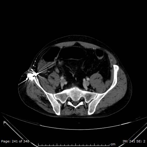 Acute superior mesenteric artery occlusion (Radiopaedia 43636-47060 Axial C+ portal venous phase 45).jpg