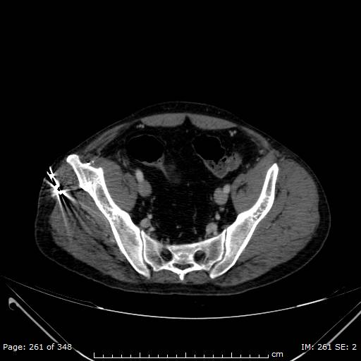 Acute superior mesenteric artery occlusion (Radiopaedia 43636-47060 Axial C+ portal venous phase 51).jpg