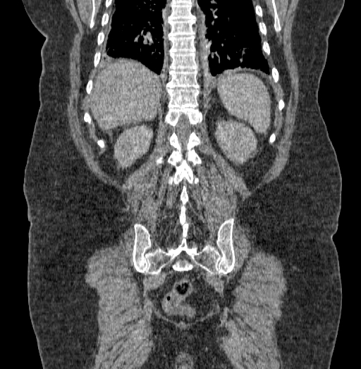 Acute superior mesenteric artery occlusion (Radiopaedia 51288-56960 Coronal C+ portal venous phase 60).jpg