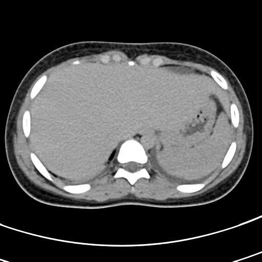 File:Acute suppurative pyelonephritis (Radiopaedia 18306-18147 Axial renal excretory phase 7).jpg
