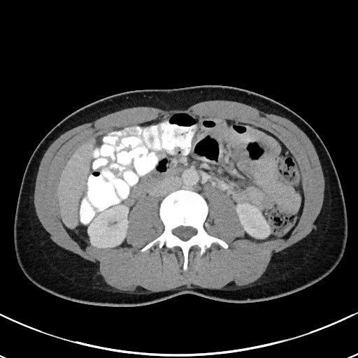 Acute uncomplicated appendicitis (Radiopaedia 61374-69304 Axial C+ portal venous phase 55).jpg