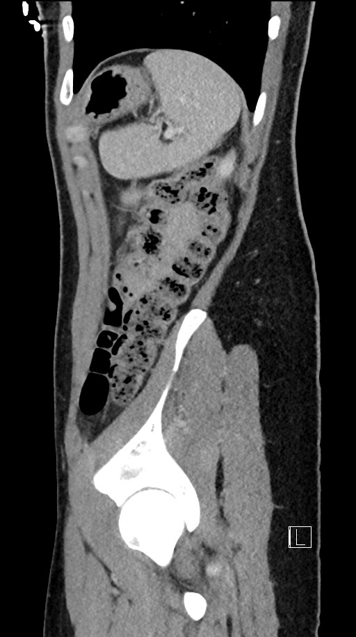 Acute uncomplicated appendicitis (Radiopaedia 61374-69304 Sagittal C+ portal venous phase 20).jpg