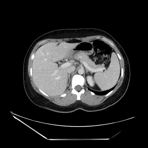 Acute uncomplicated appendicitis (Radiopaedia 73704-84499 Axial C+ portal venous phase 40).jpg