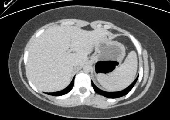 File:Acute unilateral nonhemorrhagic adrenal infarction (Radiopaedia 67560-76957 Axial renal excretory phase 5).jpg