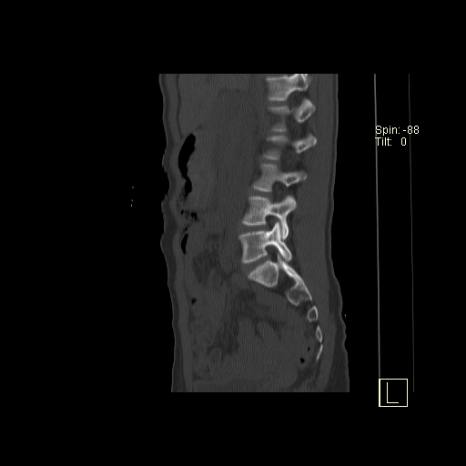 File:Acute vertebral compression fracture (Radiopaedia 63832-72559 Sagittal bone window 20).jpg