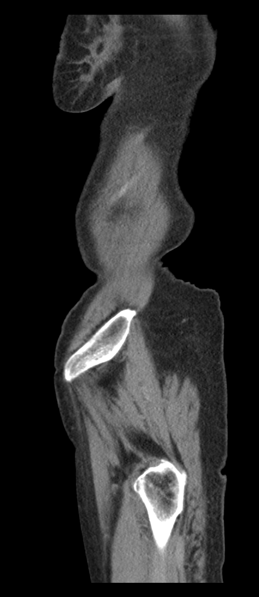 Adenocarcinoma of cecum (Radiopaedia 59222-66549 Sagittal C+ portal venous phase 96).jpg