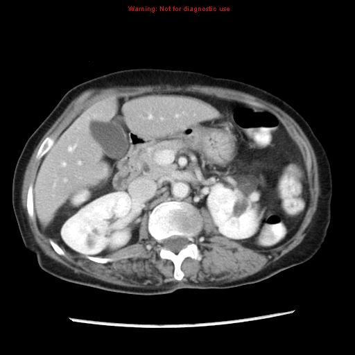 Adenocarcinoma of the colon (Radiopaedia 8191-9039 Axial liver window 28).jpg