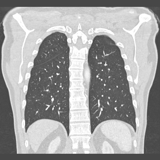 Adenocarcinoma of the lung (Radiopaedia 59871-67325 Coronal lung window 49).jpg