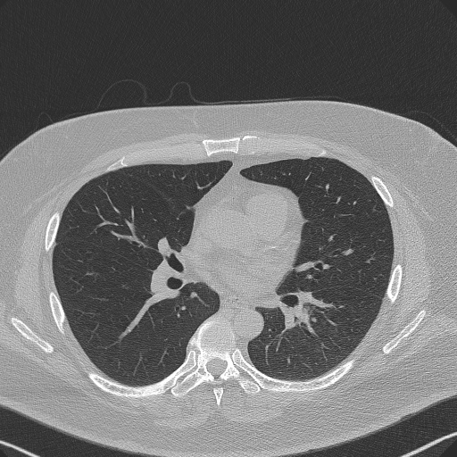 Adenoid cystic carcinoma of the trachea (Radiopaedia 49042-54137 Axial lung window 181).jpg