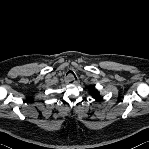 File:Adenoid cystic carcinoma of the trachea (Radiopaedia 49042-54137 Axial non-contrast 20).jpg