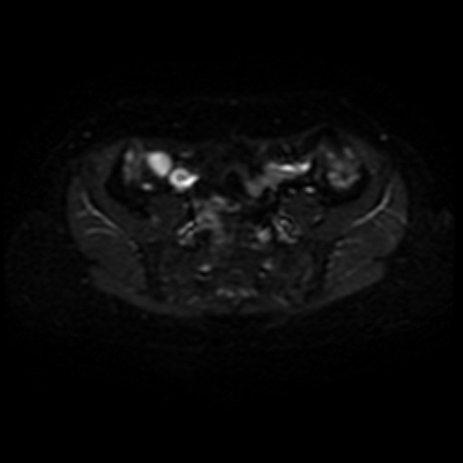Adenoma malignum of cervix (Radiopaedia 66441-75705 Axial DWI 2).jpg
