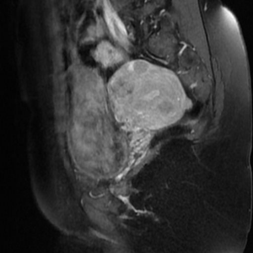 File:Adenoma malignum of cervix (Radiopaedia 66441-75705 Sagittal T1 C+ fat sat 6).jpg