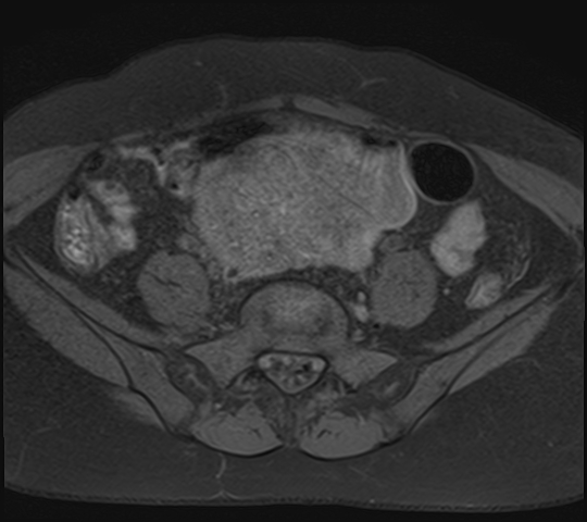 File:Adenomyosis - ovarian endometriomas (Radiopaedia 67031-76350 Axial T1 fat sat 6).jpg