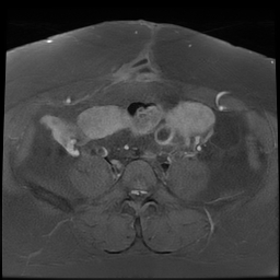 File:Adenomyosis within a didelphys uterus (Radiopaedia 70175-80215 Axial T1 C+ fat sat 14).jpg