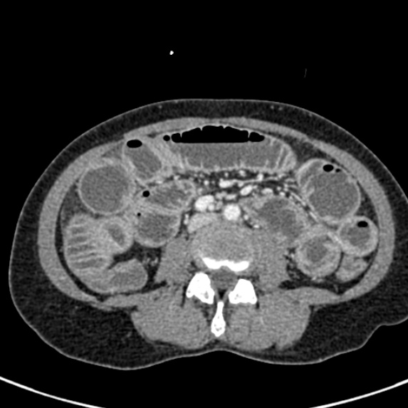 Adhesional small bowel obstruction (Radiopaedia 48397-53305 Axial C+ portal venous phase 47).jpg