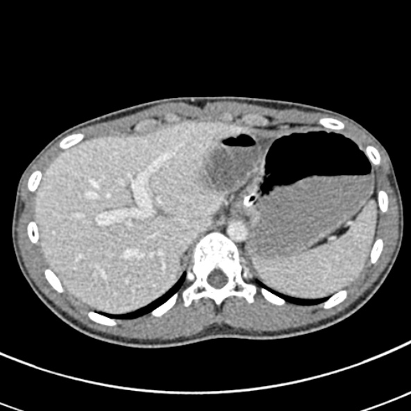 File:Adhesional small bowel obstruction (Radiopaedia 52107-57980 Axial C+ portal venous phase 20).jpg