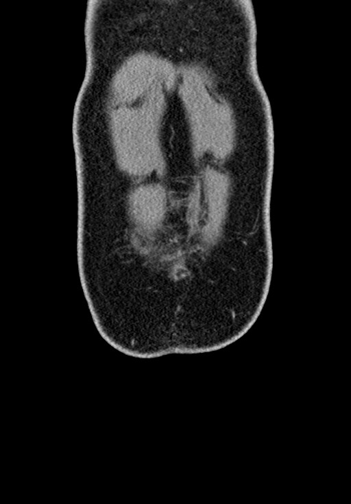 Adhesional small bowel obstruction (Radiopaedia 58900-66131 Coronal C+ portal venous phase 55).jpg