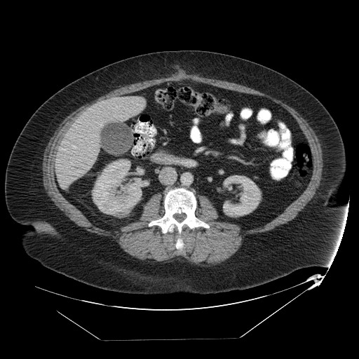 Adrenal angiosarcoma (Radiopaedia 81081-94671 Axial C+ portal venous phase 39).jpg
