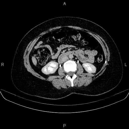 Adrenal cortical carcinoma (Radiopaedia 84882-100379 Axial C+ delayed 43).jpg