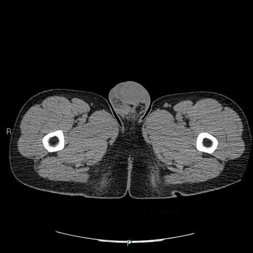 File:Adrenal cystic lymphangioma (Radiopaedia 83161-97534 Axial non-contrast 116).jpg