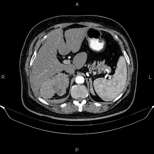 Adrenal hemorrhage (Radiopaedia 62622-70916 Axial C+ arterial phase 97).jpg