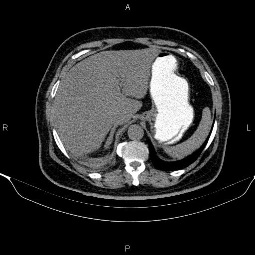 Adrenal hemorrhage (Radiopaedia 62622-70916 Axial non-contrast 32).jpg