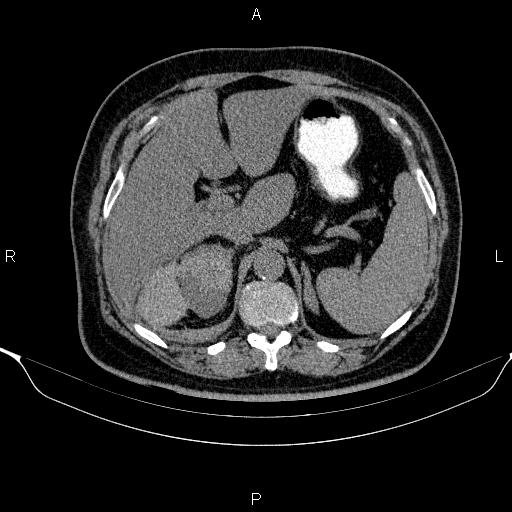Adrenal hemorrhage (Radiopaedia 62622-70916 Axial non-contrast 45).jpg
